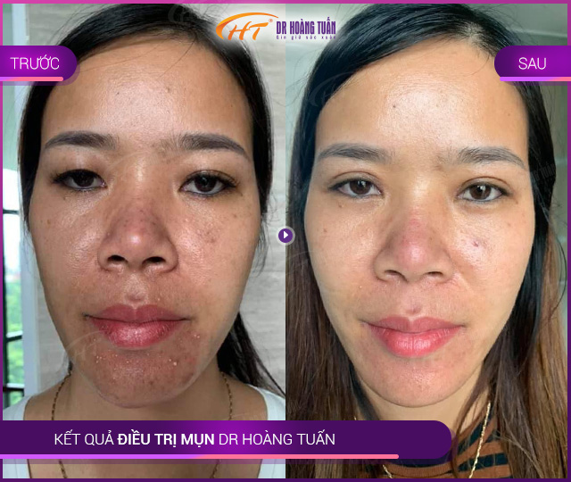 Kết quả trị mụn Thẩm mỹ Hoàng Tuấn